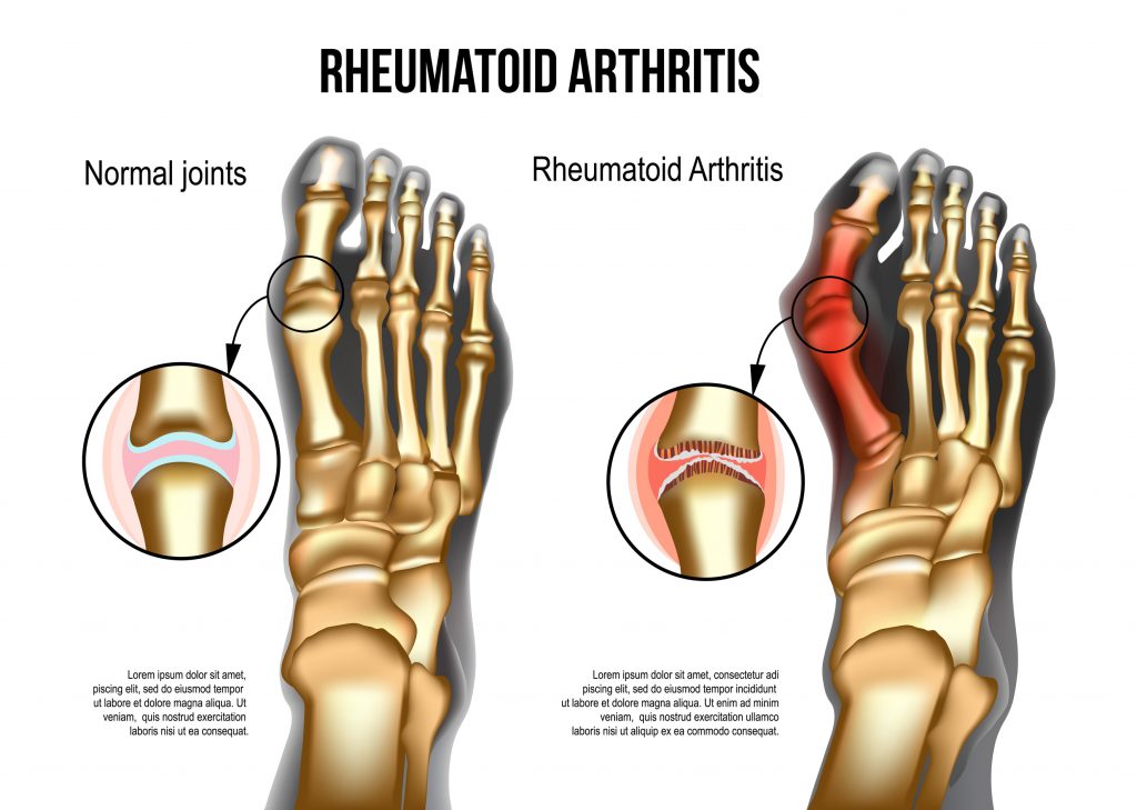 Bones of foot normal and rheumatoid arthritic sore joints, top view. Rheumatoid arthritis / ID 134436090 © Iryna Dviliuk | Dreamstime.com