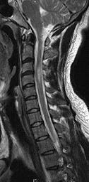 MS My Healing Story Spinal Plaque MRI